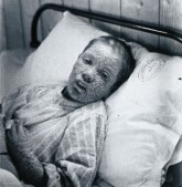 Child suffering from Smallpox in 1896